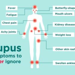 When do you need to be hospitalized for lupus