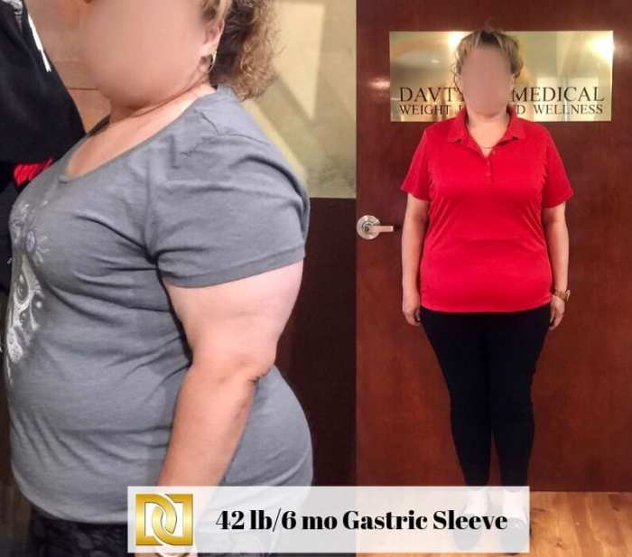 How soon can i drive after gastric sleeve surgery