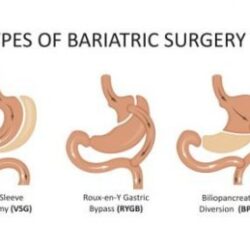 Bariatric surgery know works does work healthcare