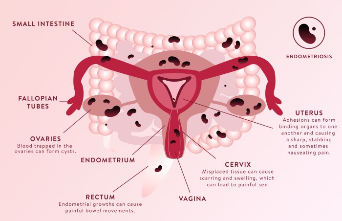 How do i know if i have endometriosis quiz