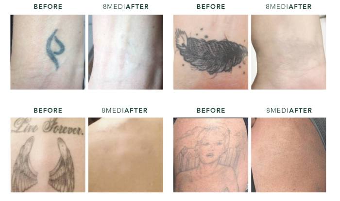 How long after tattoo removal can you get another