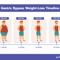 Why am i not losing weight after gastric bypass