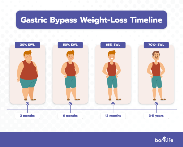 When do you stop losing weight after gastric sleeve