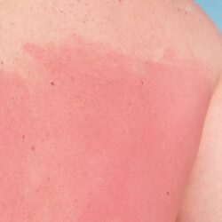 After-sun care tips for seniors to soothe sunburns