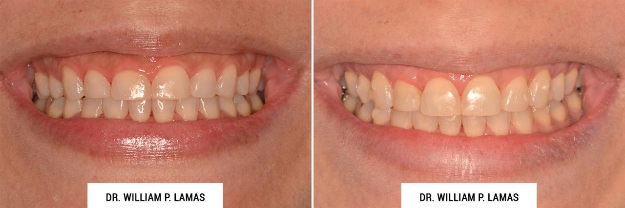 Crown lengthening before and after