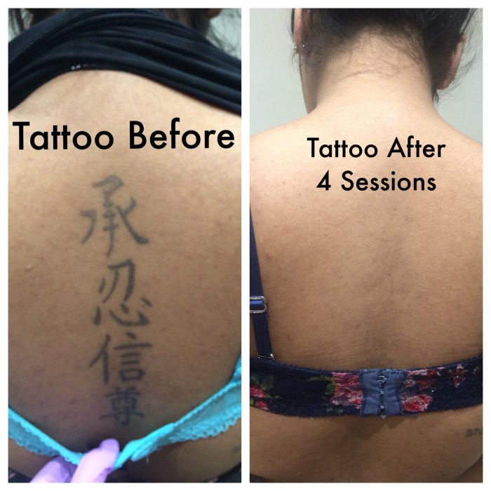 Can you get a tattoo over laser tattoo removal