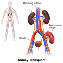 How long do you need a caregiver after kidney transplant