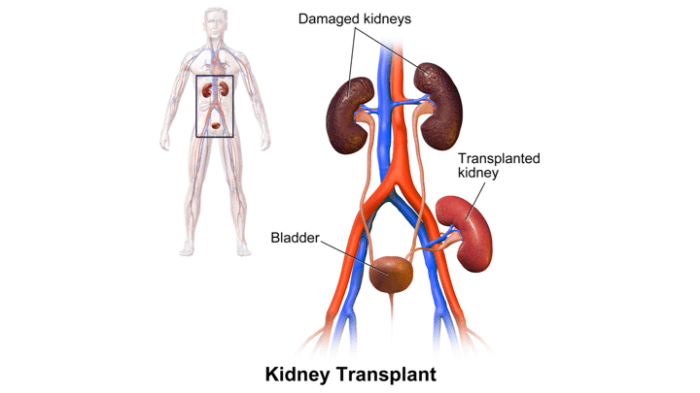 How long do you need a caregiver after kidney transplant