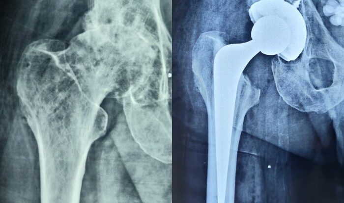 How long before i can drive after hip replacement surgery