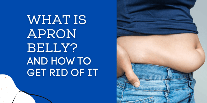 Can you get rid of apron belly without surgery