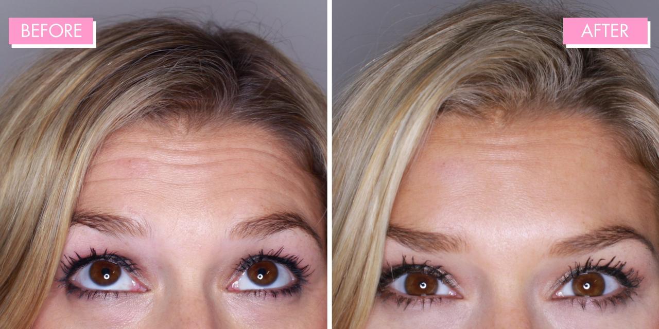 40 units of botox before and after
