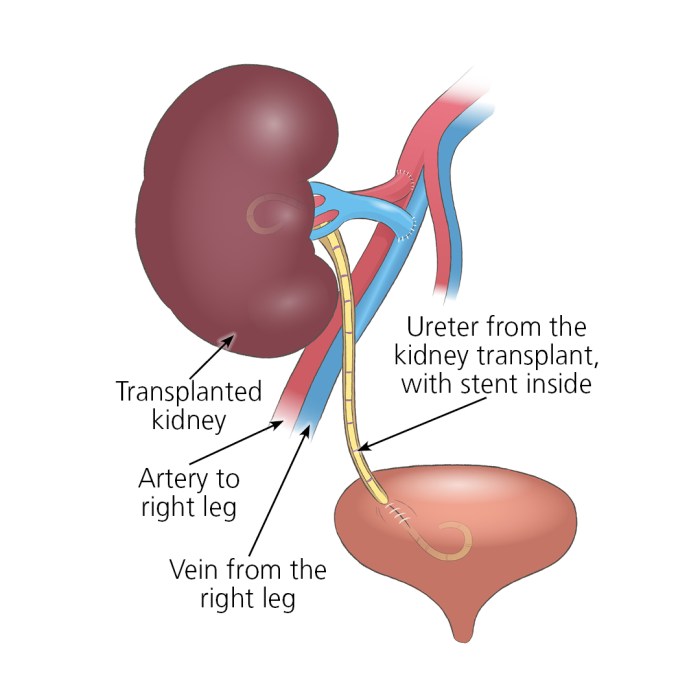 How long do you need a caregiver after kidney transplant